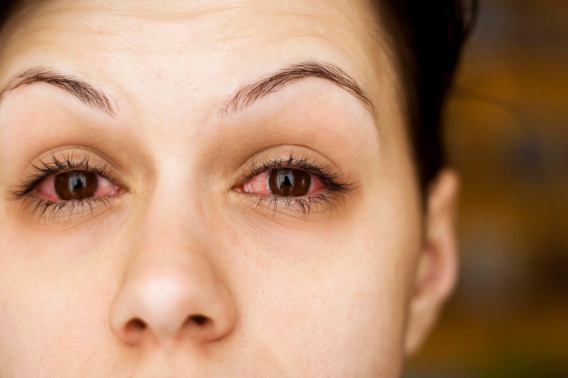 Bác sĩ chỉ ra nguyên nhân gây bệnh đau mắt đỏ ở người lớn và dấu hiệu cần đi khám ngay - Ảnh 1
