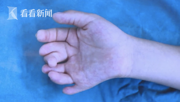 polydactyly 3