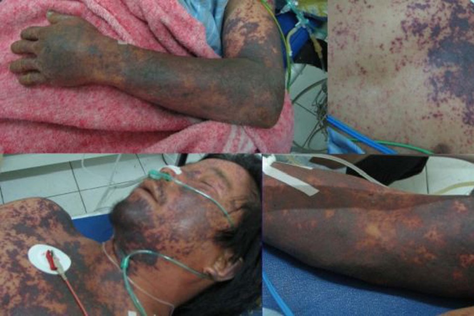 Nam Định: Người đàn ông khỏe mạnh tử vong sau 1 ngày ăn tiết canh liên hoan - Ảnh 2