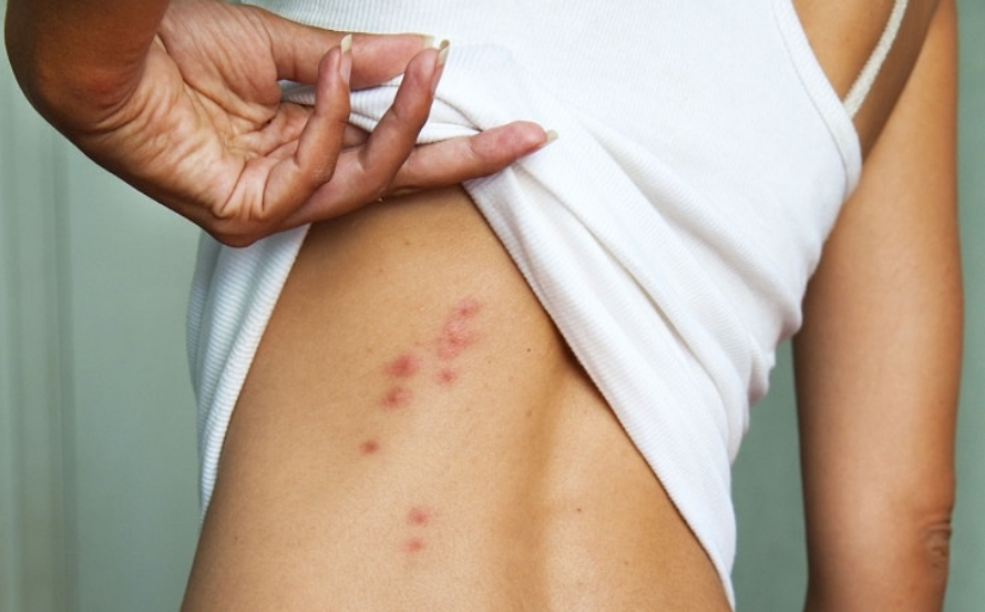 7 biện pháp khắc phục tình trạng ngứa da trong mùa hè tại nhà hiệu quả và cực kỳ an toàn - Ảnh 1