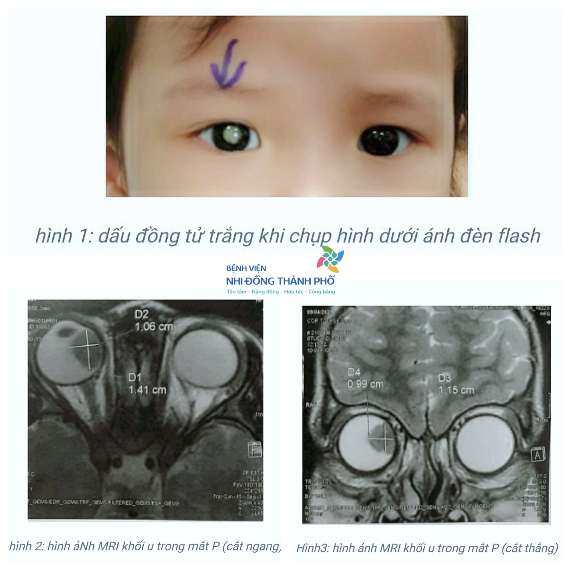 Một bệnh nhi phải cắt bỏ 1 bên mắt dù không có dấu hiệu bất thường về sức khỏe, bác sĩ lưu ý đặc biệt cho phụ huynh khi chăm sóc mắt cho trẻ - Ảnh 1
