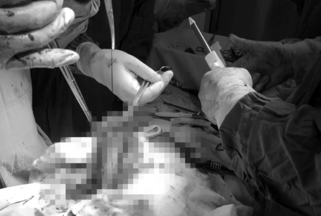 Cô gái 26 tuổi nhập viện lúc rạng sáng trong tình trạng say khướt: Nguy kịch vì vỡ lách, vỡ dạ dày do tai nạn giao thông - Ảnh 1