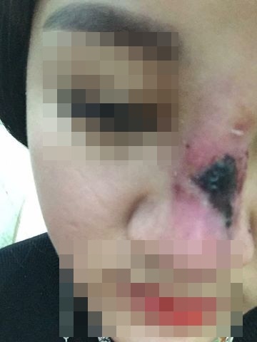 Bắc Giang: Kinh hoàng cô gái thủng sống mũi, lòi sụn vì tin lời 'bác sĩ phẫu thuật thẩm mỹ' 17 tuổi - Ảnh 3