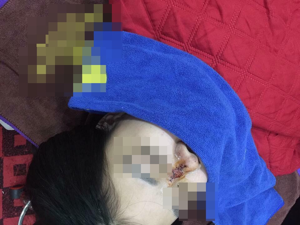 Bắc Giang: Kinh hoàng cô gái thủng sống mũi, lòi sụn vì tin lời 'bác sĩ phẫu thuật thẩm mỹ' 17 tuổi - Ảnh 4