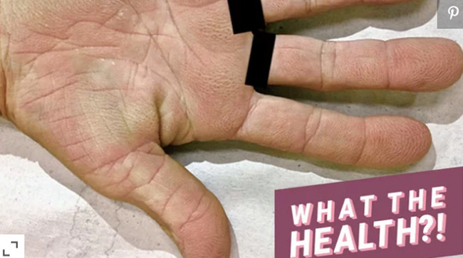 Cảnh báo: Nếu xuất hiện dấu hiệu này ở lòng bàn tay, rất có thể đã bị ung thư phổi! - Ảnh 1