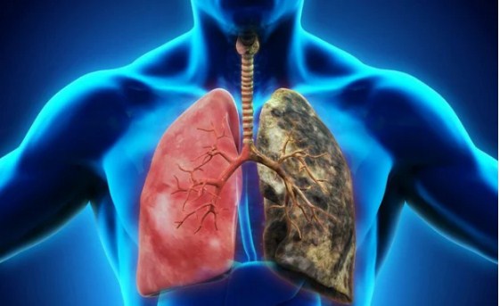 6 dấu hiệu cảnh báo sớm ung thư phổi nhiều người lầm tưởng bệnh vặt mà bỏ qua - Ảnh 2