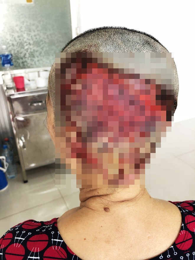 Một phụ nữ Gia Lai hoại tử da đầu nặng, vĩnh viễn không thể mọc tóc sau sự cố làm đẹp kinh hoàng - Ảnh 2