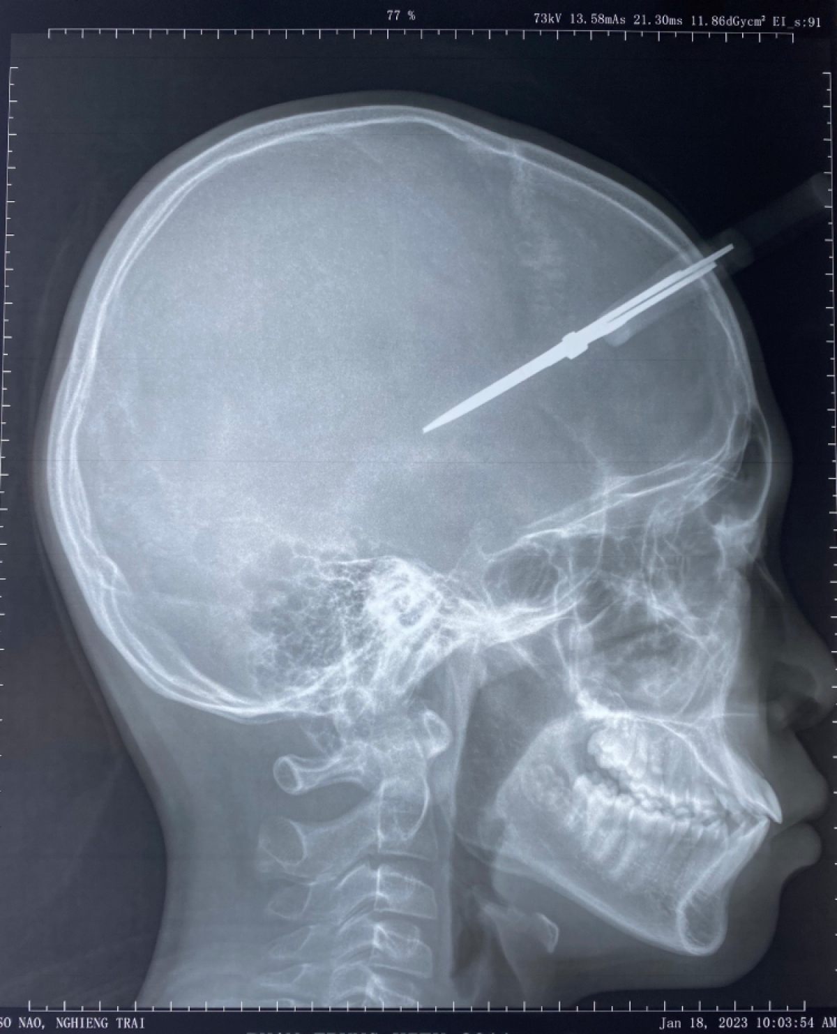 Hà Nội: Nam sinh lớp 7 bị kéo đâm thủng hộp sọ ở buổi học cuối năm - Ảnh 1