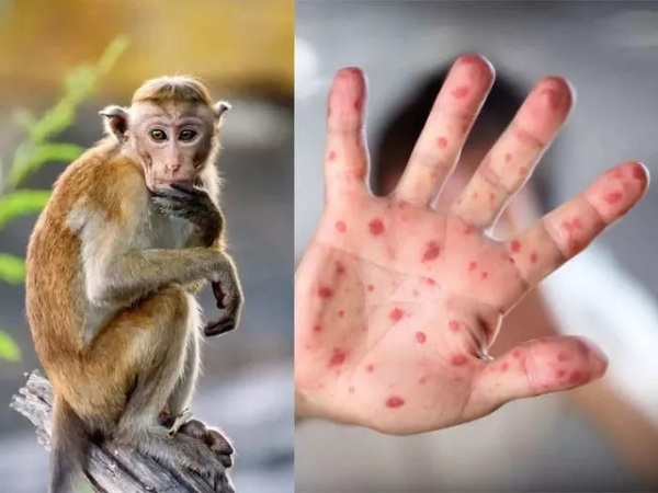 Phát hiện ca đậu mùa khỉ đầu tiên tại TP.HCM: Người dân nắm rõ ngay các triệu chứng để phòng ngừa kịp thời - Ảnh 1