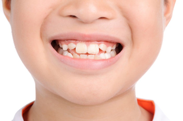Những kiểu răng mọc lệch hàm trên thường gặp nguyên nhân và cách xử lý ảnh 1