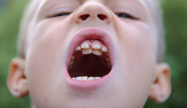 Những kiểu răng mọc lệch hàm trên thường gặp nguyên nhân và cách xử lý ảnh 2