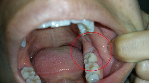 Những kiểu răng mọc lệch hàm trên thường gặp nguyên nhân và cách xử lý ảnh 3