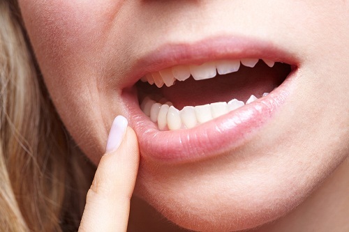 Những kiểu răng mọc lệch hàm trên thường gặp nguyên nhân và cách xử lý ảnh 4