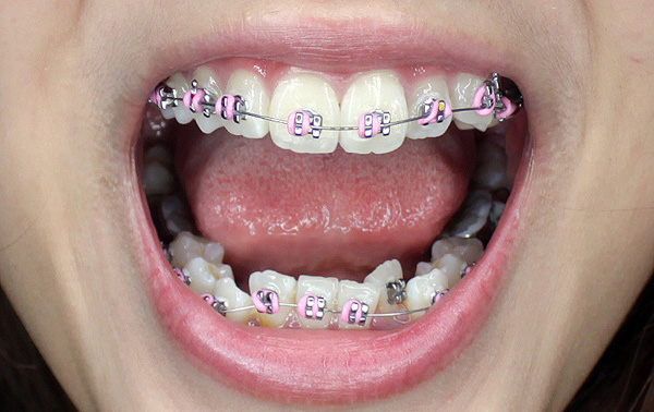 Những kiểu răng mọc lệch hàm trên thường gặp nguyên nhân và cách xử lý ảnh 6