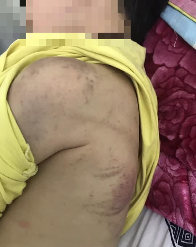 Bé trai 8 tuổi bị mẹ đánh bầm tím khắp người ở Quảng Ninh: Tiết lộ nguyên nhân bất ngờ - Ảnh 1