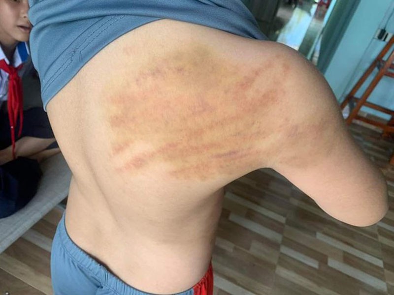 Bé trai 8 tuổi bị mẹ đánh bầm tím khắp người ở Quảng Ninh: Tiết lộ nguyên nhân bất ngờ - Ảnh 3