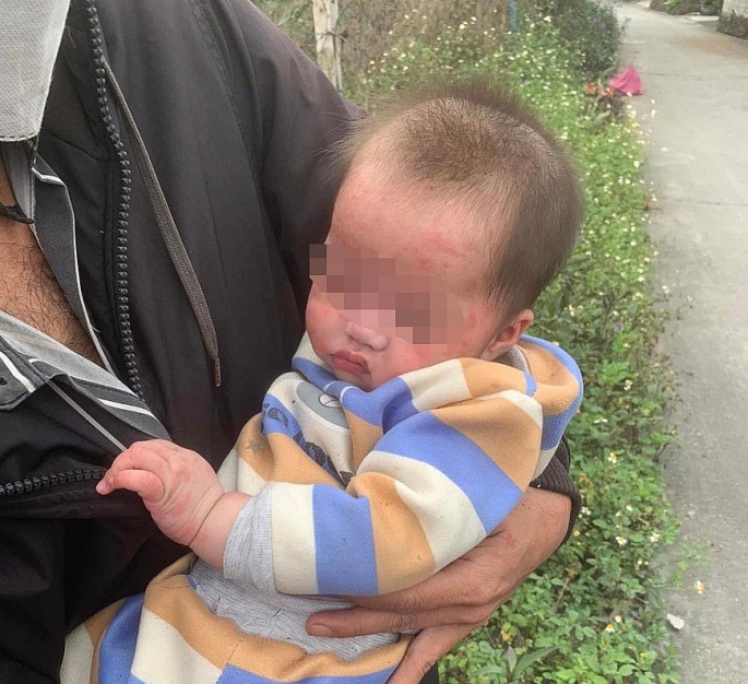 Đau xót bé gái 7 tháng tuổi bị bỏ rơi, trên mặt có nhiều vết sưng đỏ do bị muỗi đốt  - Ảnh 1