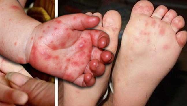 Bệnh tay chân miệng đang vào đỉnh dịch: 2 dấu hiệu 'báo động đỏ' cần đưa trẻ đến bệnh viện ngay - Ảnh 2