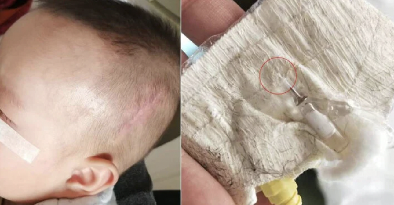 Y tá bất cẩn, ‘quên’ ống luồn kim trong đầu em bé 5 tháng tuổi suốt 5 năm, khi phát hiện, kim đã trôi xuống cổ - Ảnh 1
