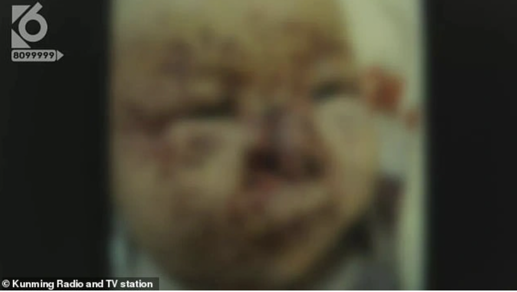 Bé sơ sinh 20 ngày tuổi bị chuột cắn chi chít vết thương trên mặt vì cơ thể thơm mùi sữa mẹ - Ảnh 2