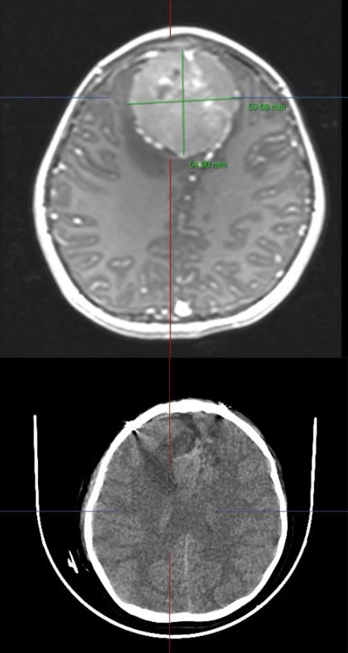Đau đầu kéo dài, bé gái 9 tuổi bất ngờ phát hiện khối u màng não khổng lồ - Ảnh 2
