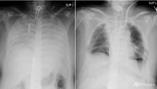 Chụp X-quang phát hiện nhiều người trẻ phổi trắng xóa, nguyên nhân vì đâu? - Ảnh 1