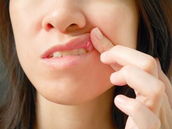 Ung thư miệng: Vết loét không phải là triệu chứng duy nhất, dấu hiệu tiềm ẩn này mới là đáng lo ngại - Ảnh 1