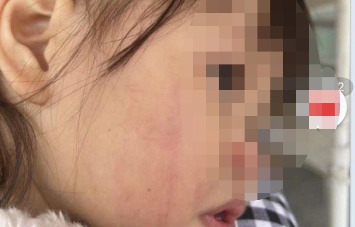 Bé gái 2 tuổi ở Hà Nội bị cô giáo đánh liên tiếp vào mặt: Cháu bé bị hoảng loạn, đêm ngủ hay giật mình khóc thét - Ảnh 2