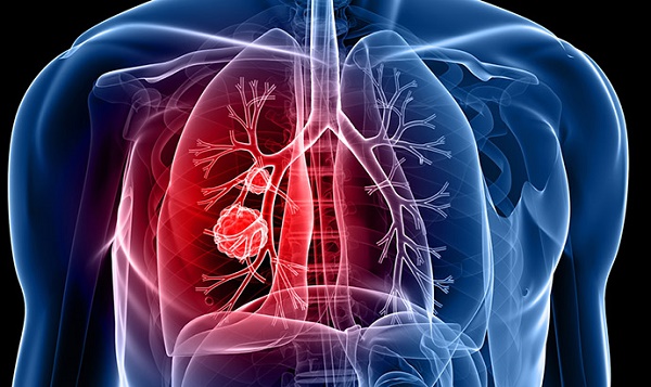 Không hút thuốc vẫn có thể mắc bệnh ung thư phổi như thường, cứ duy trì những điều này mỗi ngày chỉ có rước bệnh vào người - Ảnh 2