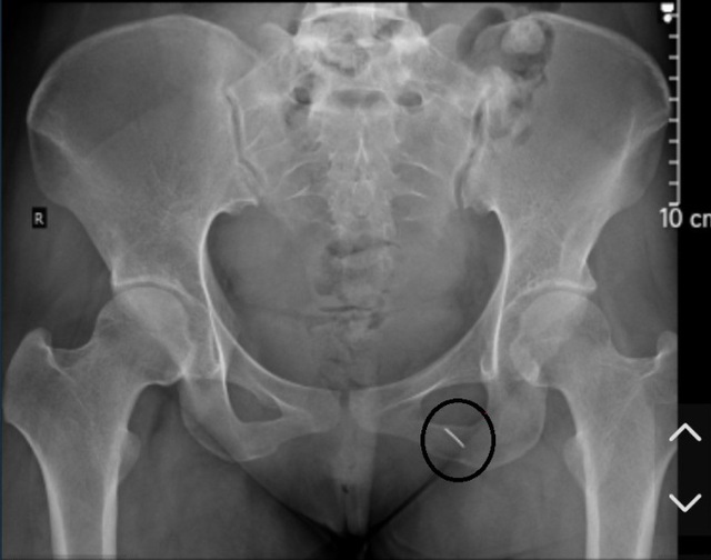 Nữ bệnh nhân phòng thượng mã phong cho chồng bị kim khâu dài đâm xuyên mông khiến cả người đau buốt - Ảnh 1