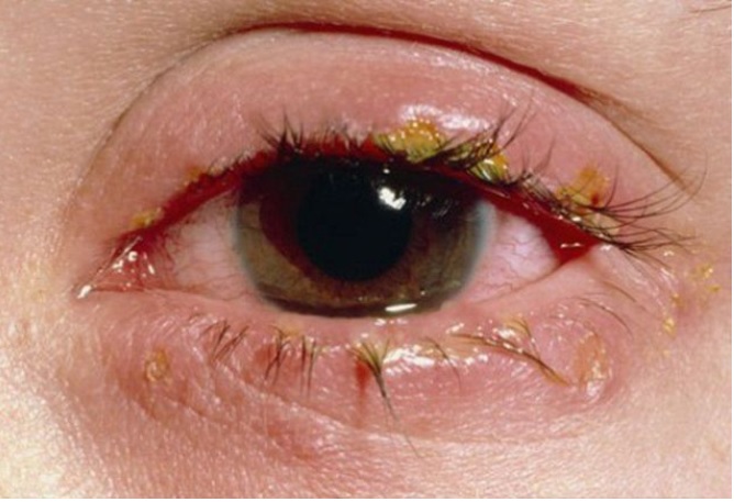 Cảnh báo nguy cơ mù mắt khi lạm dụng corticoid để trị đau mắt đỏ - Ảnh 2