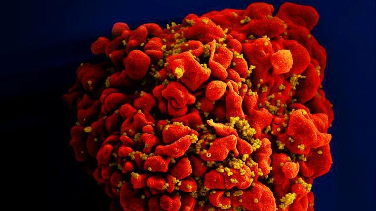 Thoát khỏi 'án tử', HIV được chữa khỏi ở bệnh nhân lớn tuổi nhất sau khi cấy ghép tế bào gốc - Ảnh 1