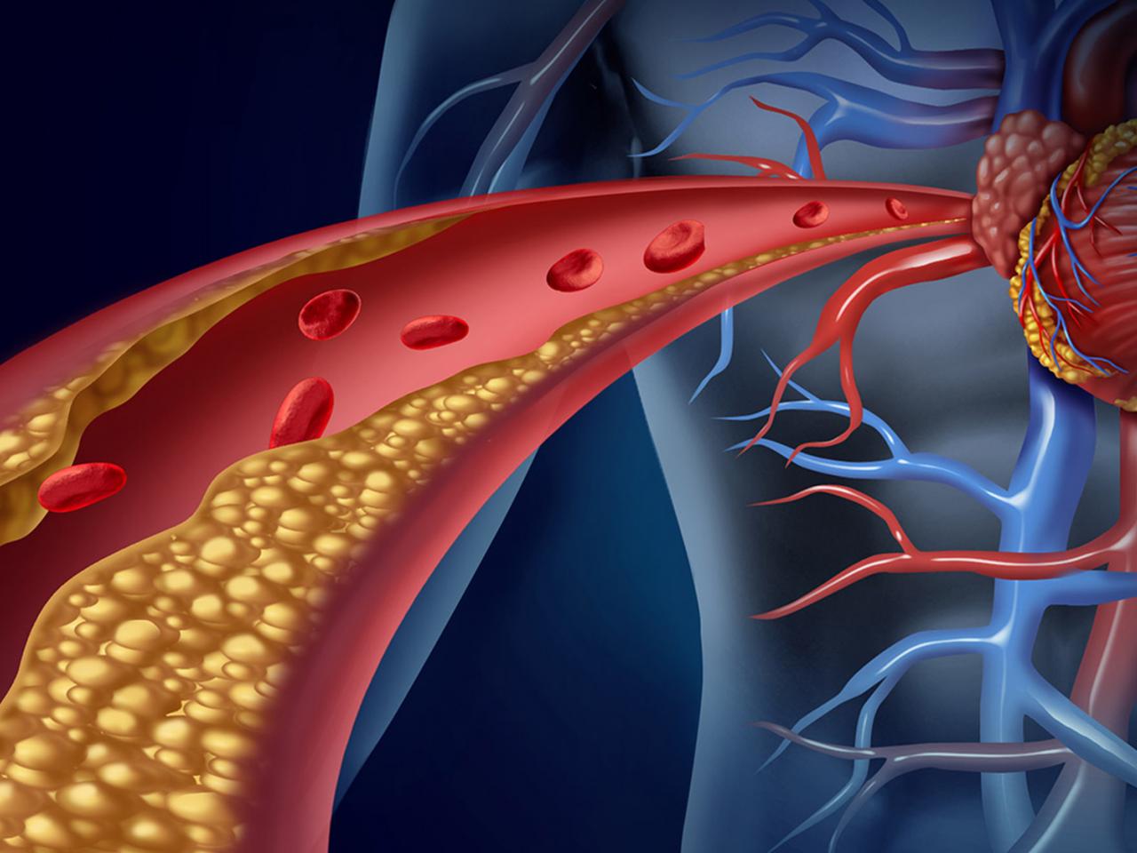 Cholesterol tăng cao : Đừng để biến chứng của 'kẻ sát nhân' gây đau tim, đột quỵ  - Ảnh 2