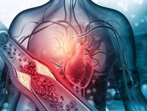 Cholesterol tăng cao : Đừng để biến chứng của 'kẻ sát nhân' gây đau tim, đột quỵ  - Ảnh 3