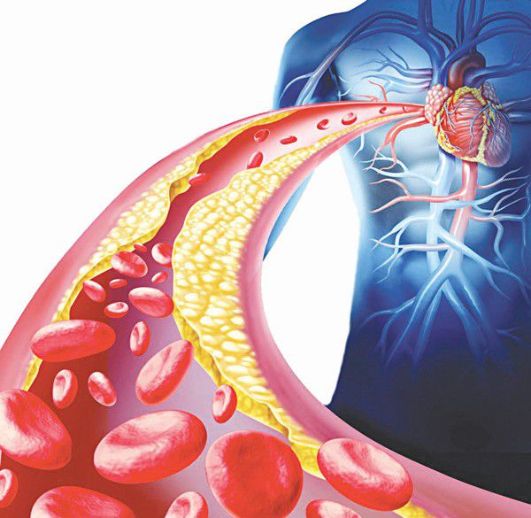 Cholesterol tăng cao : Đừng để biến chứng của 'kẻ sát nhân' gây đau tim, đột quỵ  - Ảnh 4