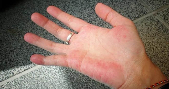 Xuất hiện dấu hiệu này trên bàn tay chứng tỏ bệnh gan đang rình rập, theo dõi kĩ để phòng tránh bệnh - Ảnh 1