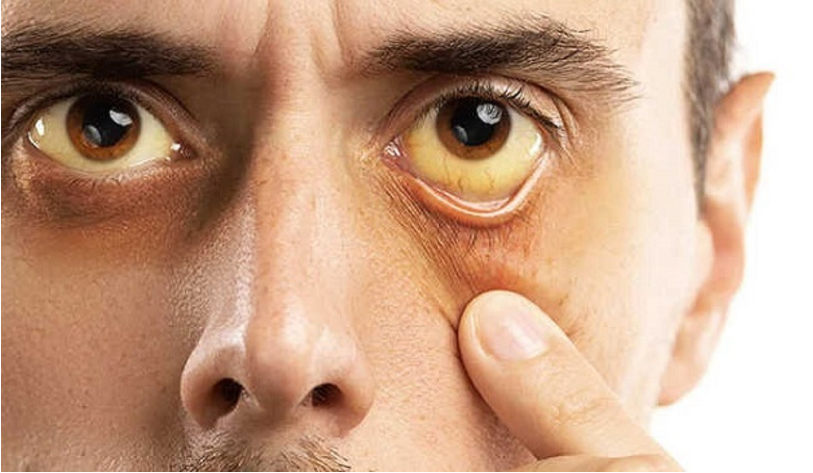 5 dấu hiệu cảnh báo cholesterol cao biểu hiện trên mặt và mắt - Ảnh 2