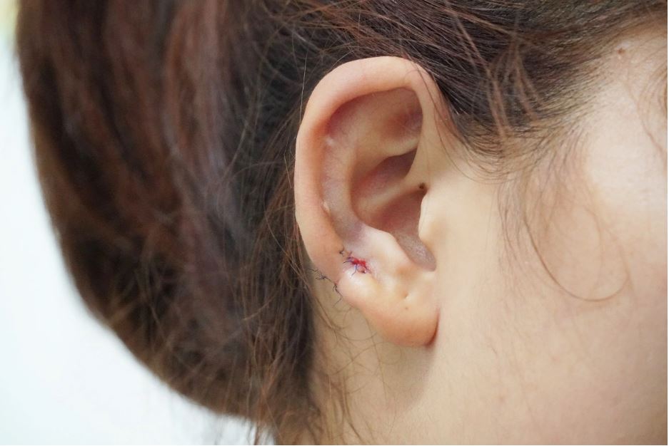 Cô gái 18 tuổi bị sẹo lồi to như khối u do bấm lỗ tai - Ảnh 2