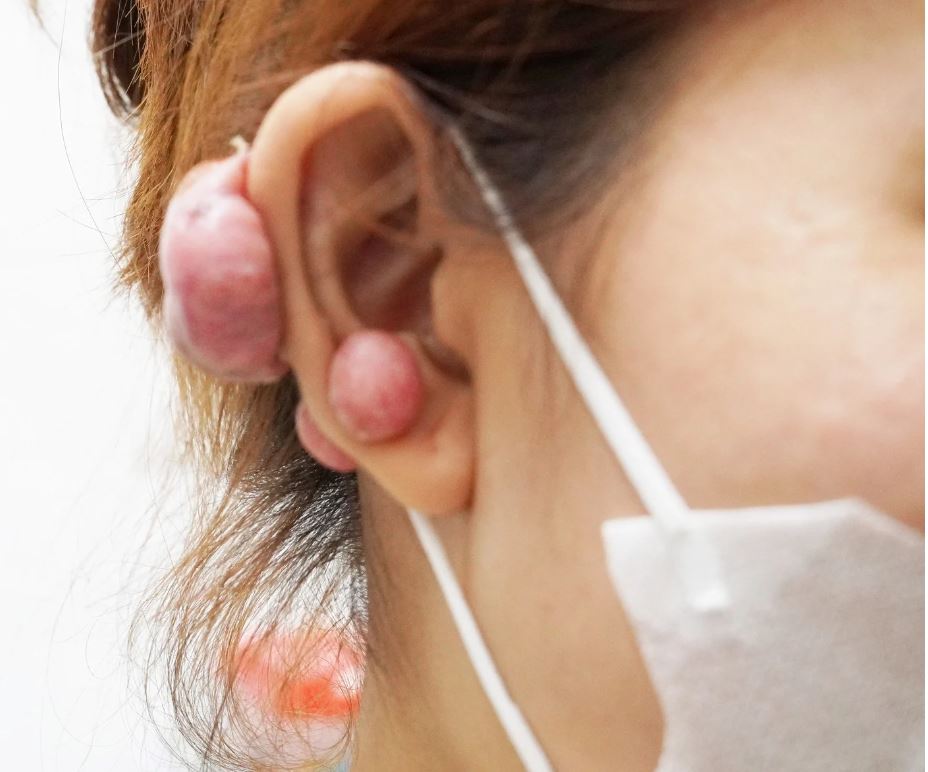 Cô gái 18 tuổi bị sẹo lồi to như khối u do bấm lỗ tai - Ảnh 1