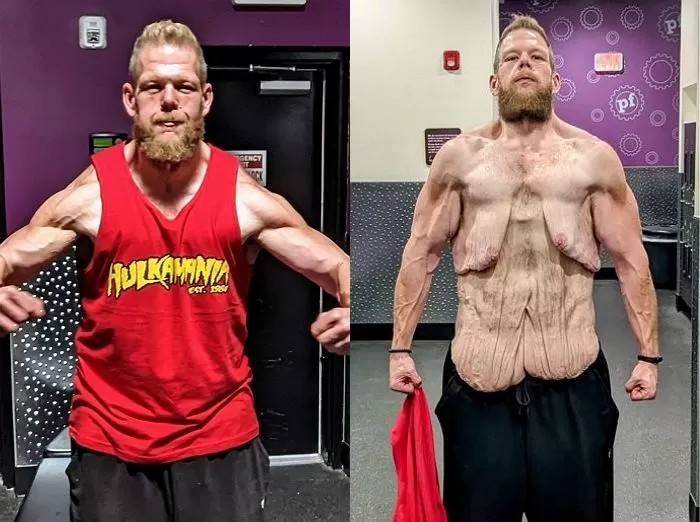 Chàng trai tự hào chia sẻ hình ảnh 'làn da chảy xệ' thay vì cơ bắp săn chắc sau khi giảm 152kg - Ảnh 3