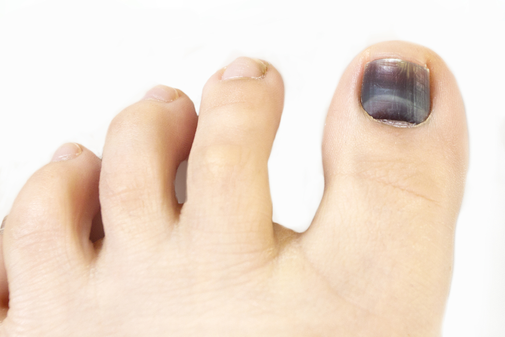 Móng chân bị thâm đen rất có thể là dấu hiệu của ung thư da