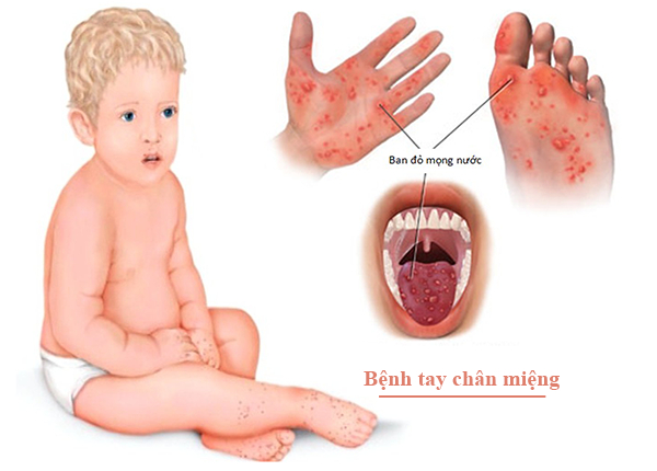 Những lưu ý quan trọng khi chăm trẻ bị tay chân miệng để tránh biến chứng nguy hiểm - Ảnh 1