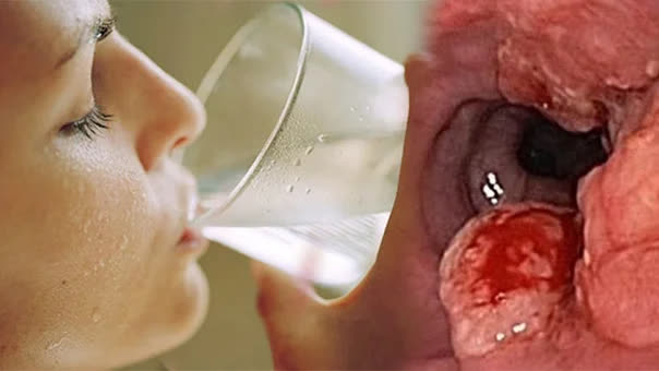 4 tín hiệu cảnh báo sớm ung thư trong lúc uống nước, ít người để ý - Ảnh 1