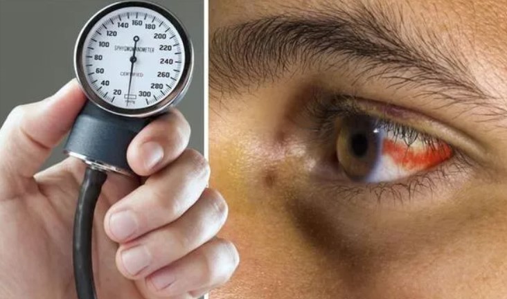 Chuyên gia cảnh báo: Đốm đỏ trong mắt có thể là dấu hiệu của huyết áp cao cực nguy hiểm - Ảnh 2