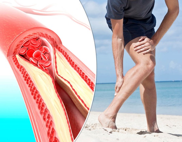 Đau chân theo cơn thường xuyên có thể cánh báo chứng Cholesterol cao, tuyệt đối đừng trì hoãn khám bệnh - Ảnh 2
