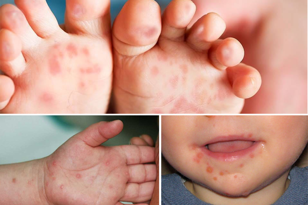 Cha mẹ cần chú ý những dấu hiệu này ở trẻ là cảnh báo bệnh tay chân miệng cần đưa con nhập viện ngay - Ảnh 2