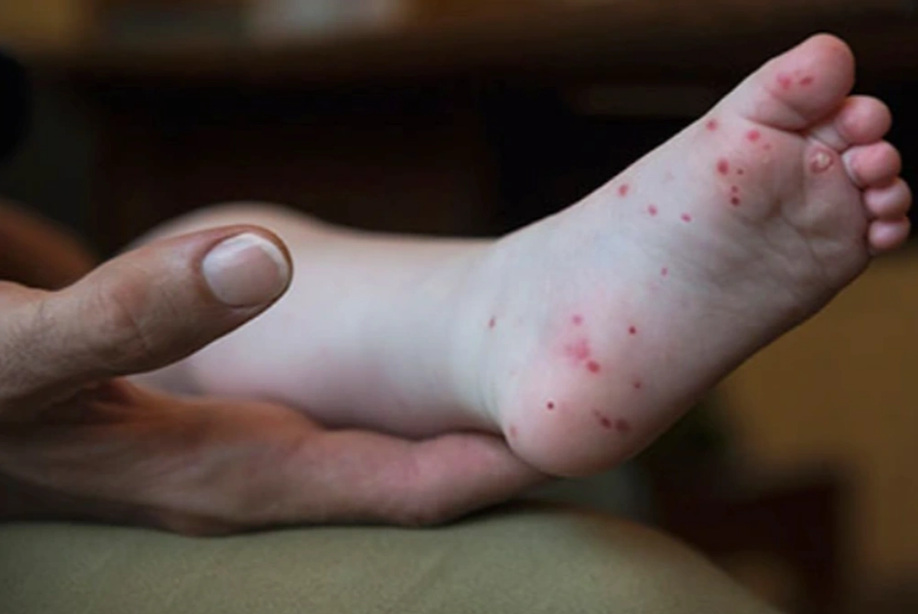 Phát hiện MỚI nhất về loại virus gây bệnh tay chân miệng nặng tại TPHCM - Ảnh 1