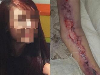 Cô gái 23 tuổi tử vong vì nhiễm vi rút ăn thịt người khi thử tư thế lạ với bạn trai