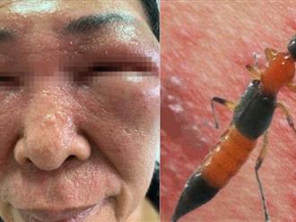 Hà Nội: Dính nọc độc của côn trùng lúc ngủ, người phụ nữ cầu cứu vì đau rát, không mở được mắt