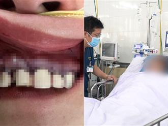 Người phụ nữ bị biến chứng vùng răng cửa, căng tức do bọc răng thẩm mỹ